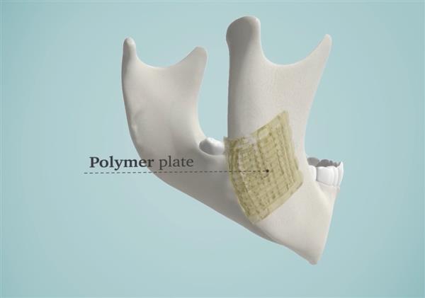 解決醫(yī)生煩惱 3D打印生物陶瓷修復(fù)骨骼
生物陶瓷,3D打印生物陶瓷,工業(yè)3d打印機(jī),3D打印機(jī)價(jià)格,3D打印服務(wù),3D打印技術(shù),中國(guó)3d打印技術(shù),上海3D打印,北京3D打印