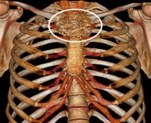 第四軍醫(yī)大學(xué)精彩分享個性化醫(yī)療3D打印的實戰(zhàn)案例與研究成果