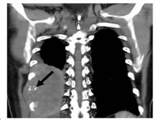 第四軍醫(yī)大學(xué)精彩分享個性化醫(yī)療3D打印的實戰(zhàn)案例與研究成果